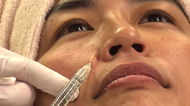 【写真を見る】顔に注射針が入り込んでいく奥山佳恵。「ちゅるちゅるって(ヒアルロン酸が)入っていく感じがしました」